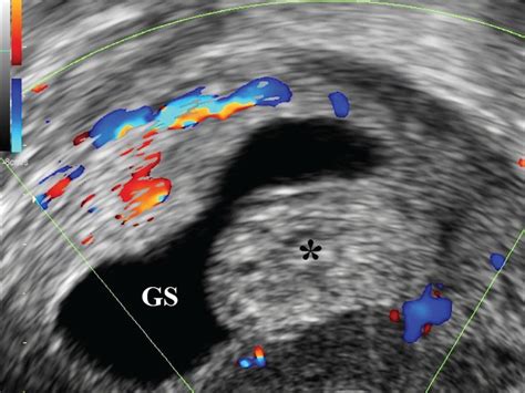 uterine polyp impact blood test|endometrial polyp test results.